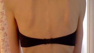 Uite in ce hal arata o adolescenta anorexica! Are 30 de kilograme si mananca doar bomboane fara zahar