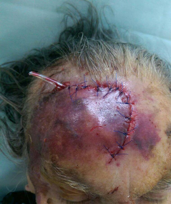 IMAGINI HORROR! Bătrână de 95 de ani, desfigurată cu bâta pentru banii de pensie! Reacţia medicului: ”N-a mai apucat, că…”
