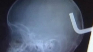 VIDEO Un bebelus a scapat cu viata, dupa ce i-a intrat in cap o tija metalica de sapte centimetri