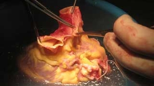 Parintii unui tanar de 18 ani in moarte clinica au acceptat sa ii doneze organele! Patru vieti au fost salvate