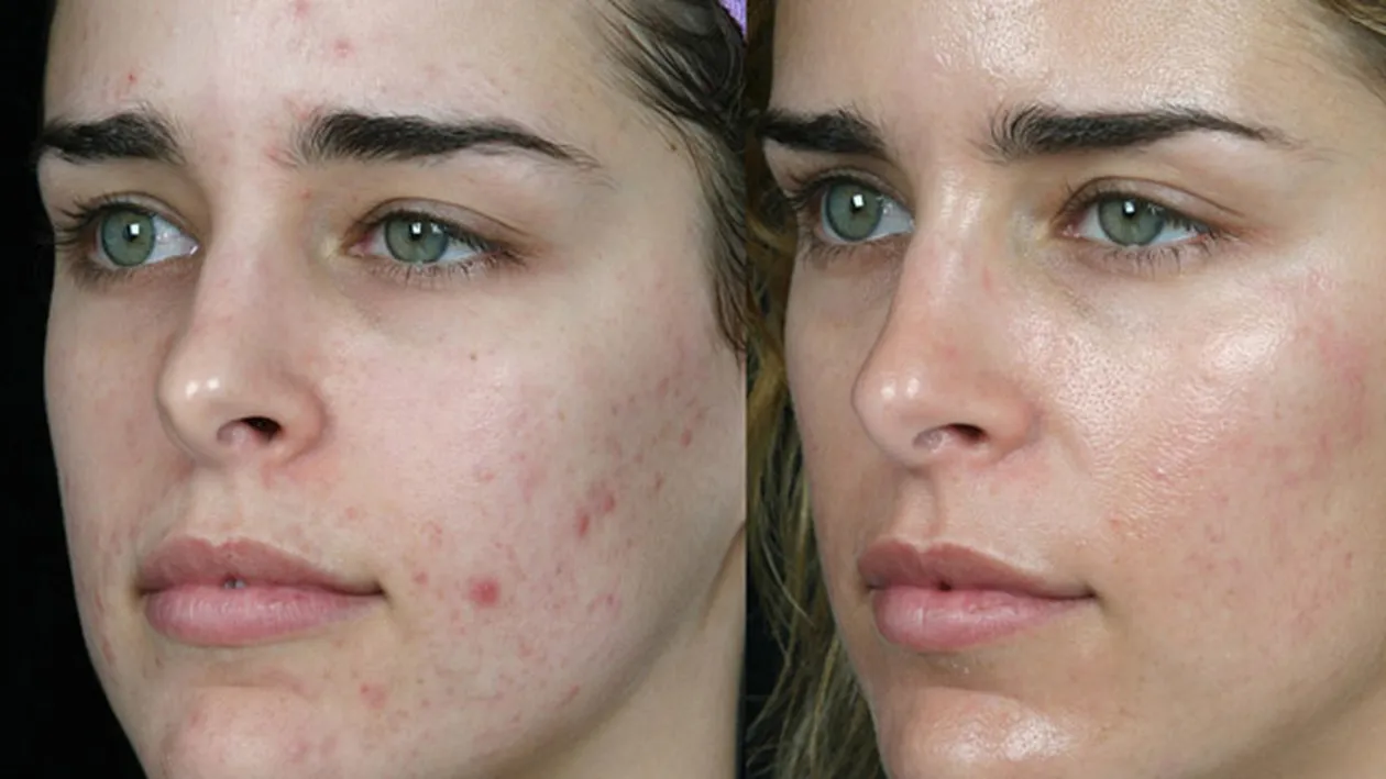 Andreea Ibacka foloseste un tratament antiacneic pe care-l prepara cu mai putin de 1 leu! Il poti realiza chiar la tine acasa