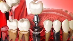 Cât rezistă un implant dentar? Află durata medie de viață