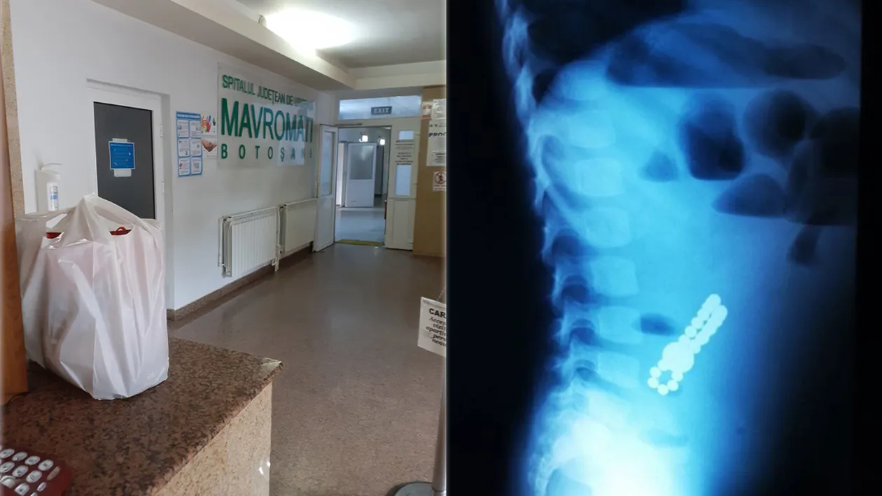 Trei copii din Botoșani, operați de urgență după ce au ajuns la spital cu perforații la nivelul intestinului: “Acești magneți sunt foarte puternici”. Semnalul de alarmă tras de medici
