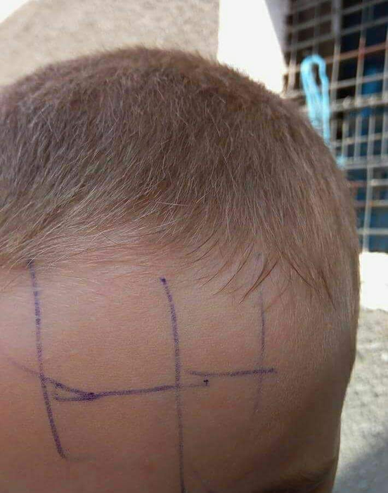 Semnele făcute cu pixul de către educatoare, pe capul fruntea copilului