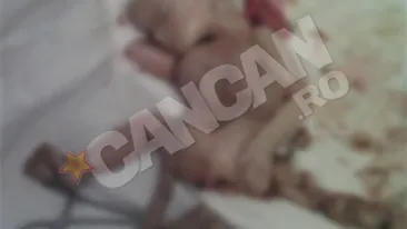 IMAGINI SOCANTE Caz foarte rar in lume! O femeie isi purta fatul mort de doua luni, in abdomen