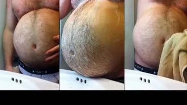 Acest bărbat avea o burta uriașă care îi creștea în fiecare zi. Medicii care l-au operat au rămas înmărmuriți când l-au deschis!
