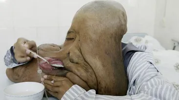 Iti garantam ca nu o sa te poti uita la poza asta mai mult de cateva secunde! Cea mai cumplita tumoare! Nu mai arata a OM!