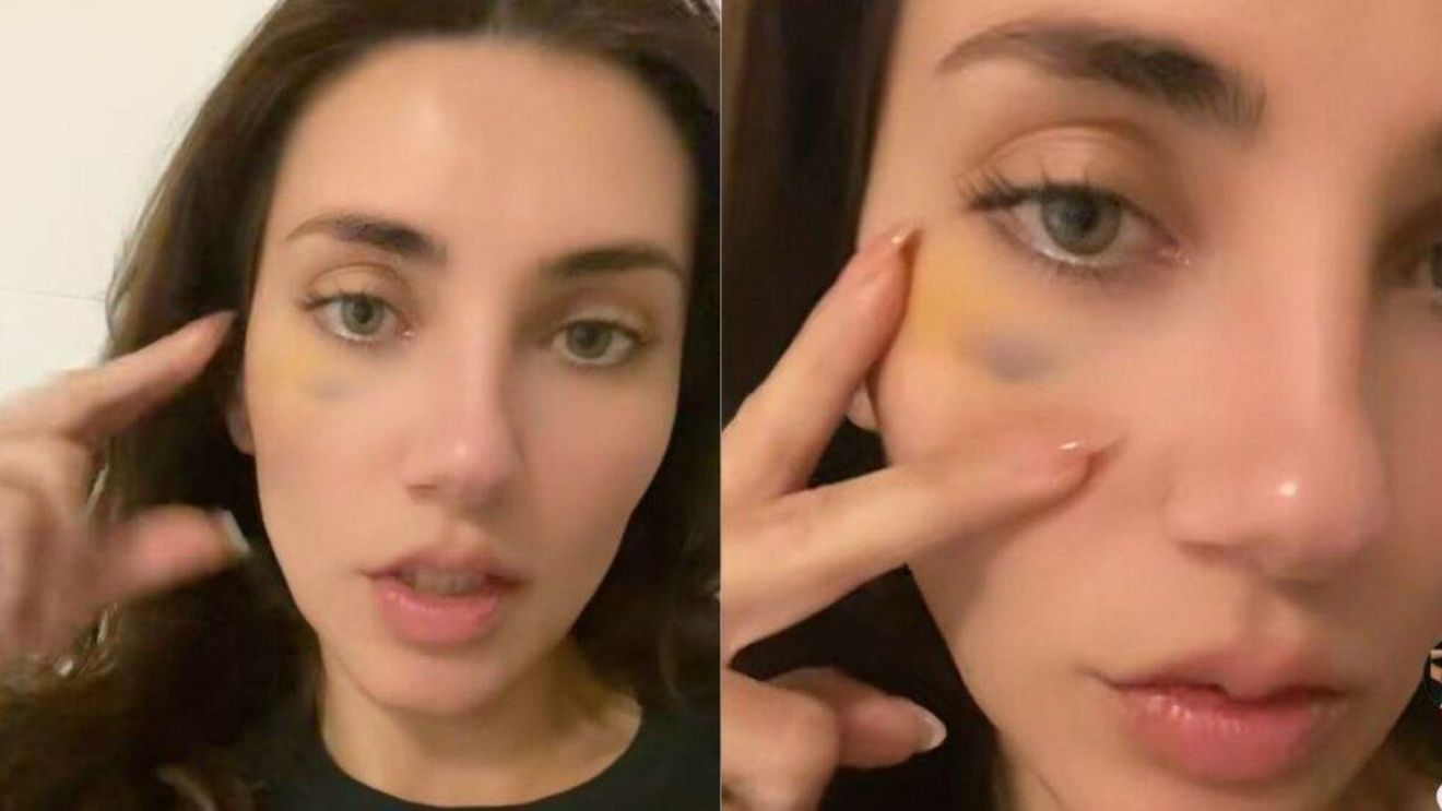Coșmar total după o procedură estetică! Ce a pățit o tânără după ce și-a făcut o intervenție la față