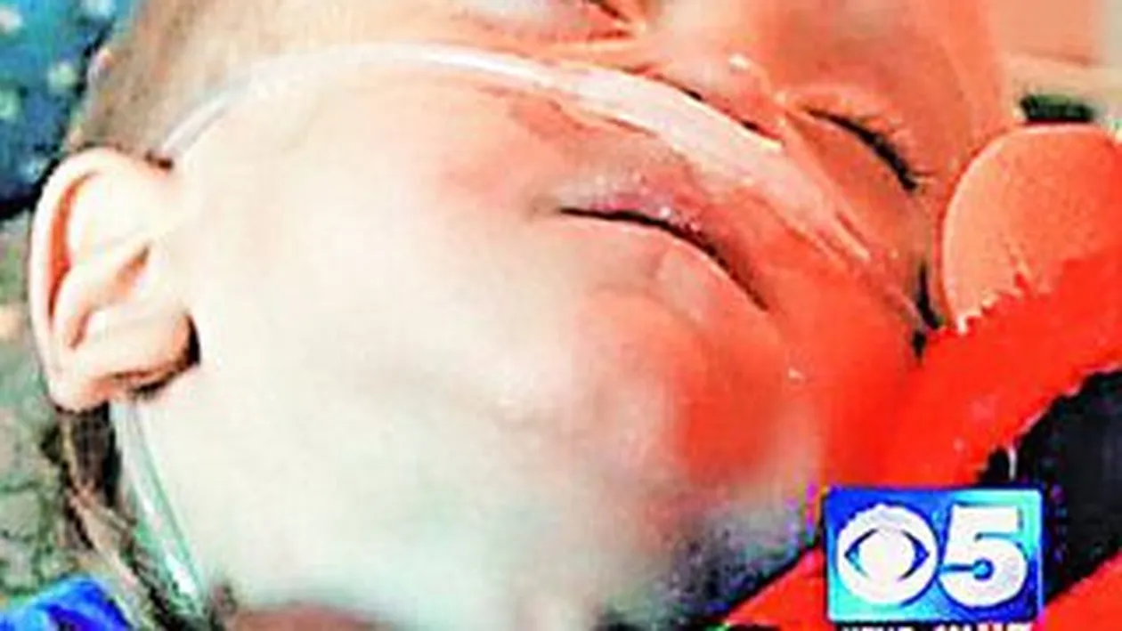 Un copil a suferit arsuri cumplite dupa ce a inghitit o baterie cu litiu. 18 operatii intr-un an