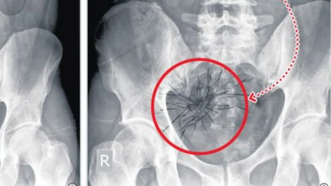Chirurgul Gheorghe Ștefan din Constanța, protagonistul unui nou caz incredibil de grav. După foarfeci, a uitat și un „ghem” de ațe în pântecele unui alt pacient