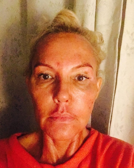 Natascha Ochsenknecht, la o zi după tratamentul facial