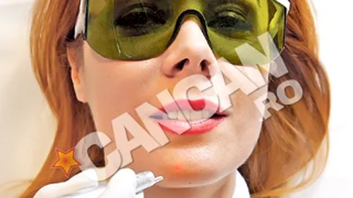 Ultima tehnologie utilizata in intinerirea faciala! Dana Savuica sterge semnele trecerii timpului cu Laser CO2