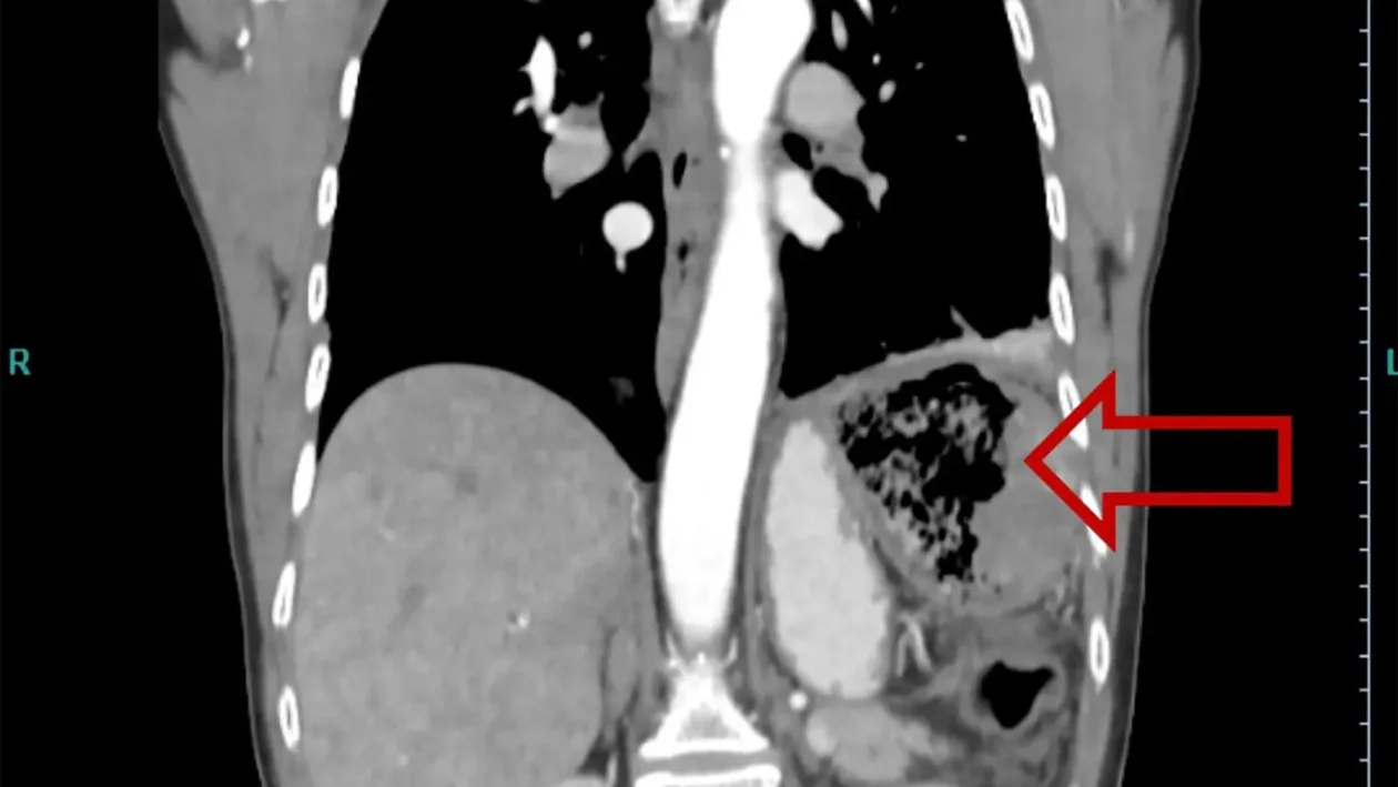 De necrezut! Ce obiect au găsit chirurgii în corpul unei femei. Fusese uitat acolo în anul 1999