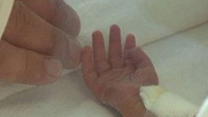 O fetita de un an a ajuns la spital dupa ce s-a ars cu soda cautica
