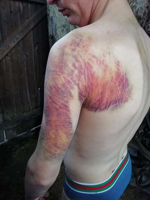 Urmele bătăii pe care tânărul ar fi primit-o la poliție