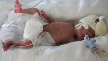 VEZI AICI cum arata doi frati gemeni care s-au nascut la 5 luni si sunt perfect sanatosi