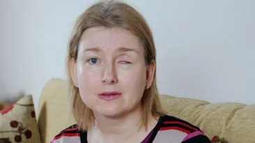 FOTOGRAFII ŞOCANTE! O mamă a doi copii şi-a pierdut un ochi din cauza lentilelor de contact!