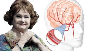 Care sunt simptomele bolii care a ucis-o pe Stela Popescu! Aceştia sunt paşii prin care le poţi recunoaşte. Află cum să te fereşti de un atac cerebral