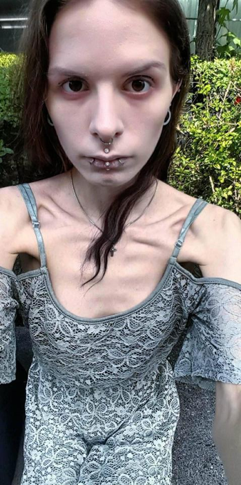 Cazul şocant al fetei care îşi ascundea mâncarea în urechi! Julia cântărea 32 de kilograme, dar a învins anorexia. Cum a reuşit!