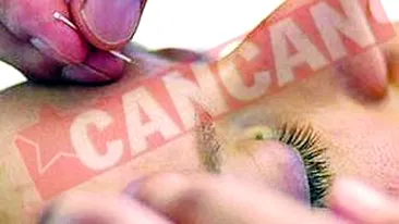 Acupunctura are aceleasi efecte ca si calmantele