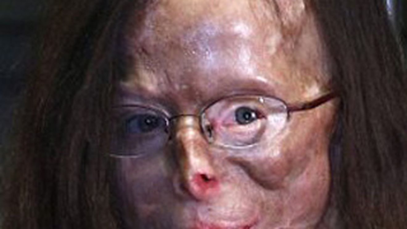 IMAGINI INGROZITOARE! Nasul i se dezintegreaza, nu mai aude si i s-a amputat un deget! Femeia asta a ajuns un cadavru, dupa ce a fost desfigurata cu vitriol de fostul amant!