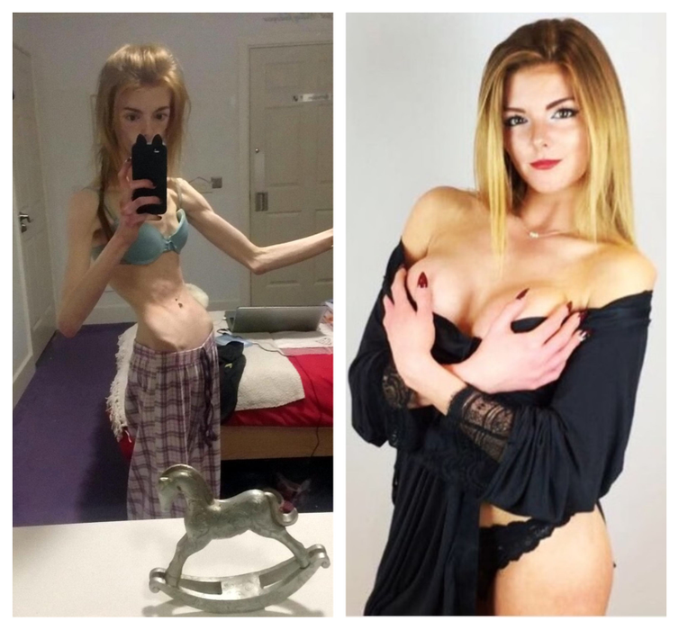 Povestea cutremurătoarea a lui Annie. Ajunsese să cântărească 28,5 kilograme și a fost salvată de un aliment considerat o minune a gastronomiei