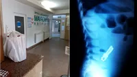 Trei copii din Botoșani, operați de urgență după ce au ajuns la spital cu perforații la nivelul intestinului: “Acești magneți sunt foarte puternici”. Semnalul de alarmă tras de medici