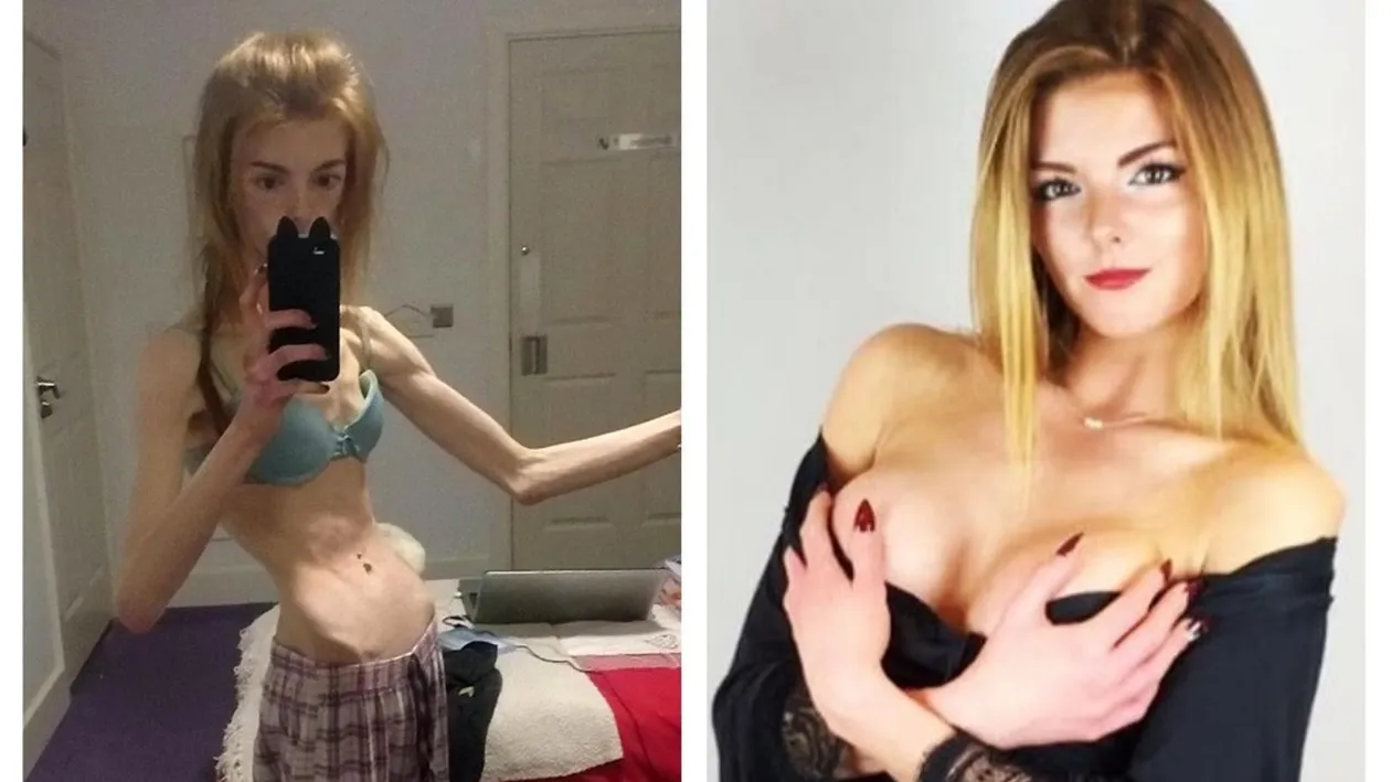 Povestea cutremurătoarea a lui Annie. Ajunsese să cântărească 28,5 kilograme și a fost salvată de un aliment considerat o minune a gastronomiei