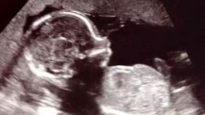 În ce moment devine conștient un fetus?