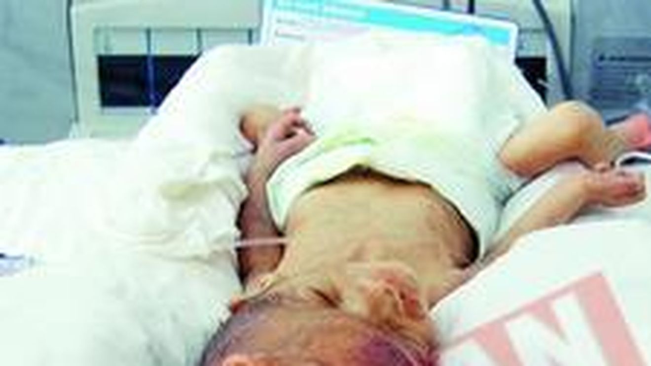 Siamezii, in stare grava