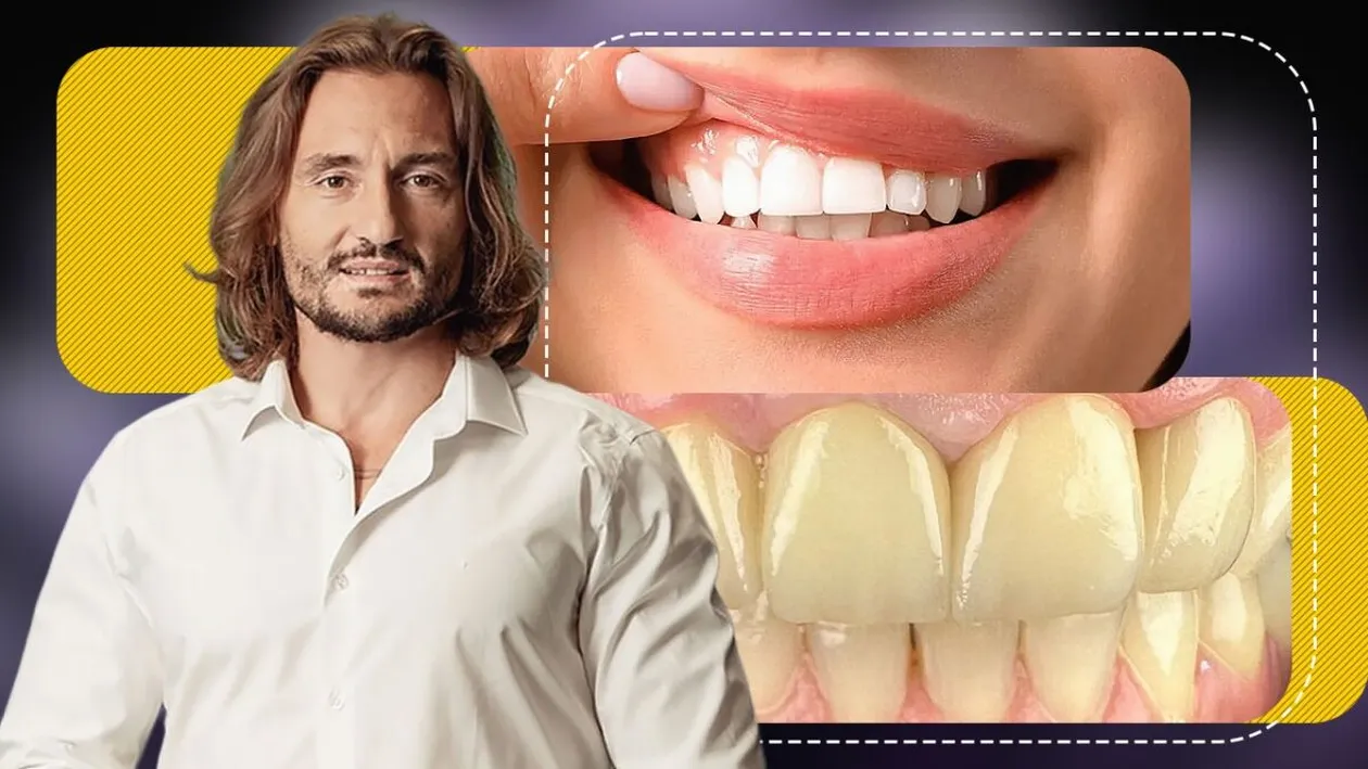 Cum își pot albi românii dinții în mod natural? Ce spune Dr. Cezar despre smalț, dentină și rolul unei vitamine importante
