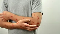 Ce este virusul mpox? A ajuns într-o țară din Europa în care locuiesc o mulțime de români