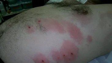 INVAZIA CAPUSELOR! Un iesean a fost muscat de 12 capuse in cateva minute in timp ce se relaxa in iarba