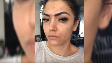 Andreea Mantea, imagini șocante. Vedetei Kanal D i-au ieșit bube pe față