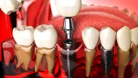 Cât rezistă un implant dentar? Află durata medie de viață