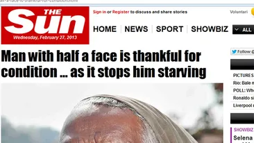 Imagini şocante! Un bărbat transfigurat de o boală rară este recunoscător pentru asta - datorită bolii am ce mânca