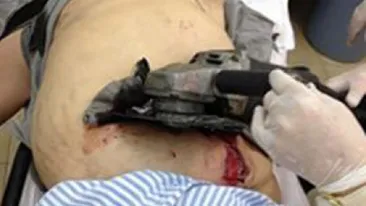 Medicii au fost socati cand l-au vazut! Un barbat a supravietuit dupa ce a avut asa ceva infipt in el