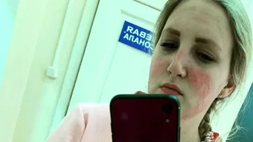 O asistentă medicală s-a ales cu arsuri pe față din cauza măștii de protecție. Cum a fost posibil așa ceva