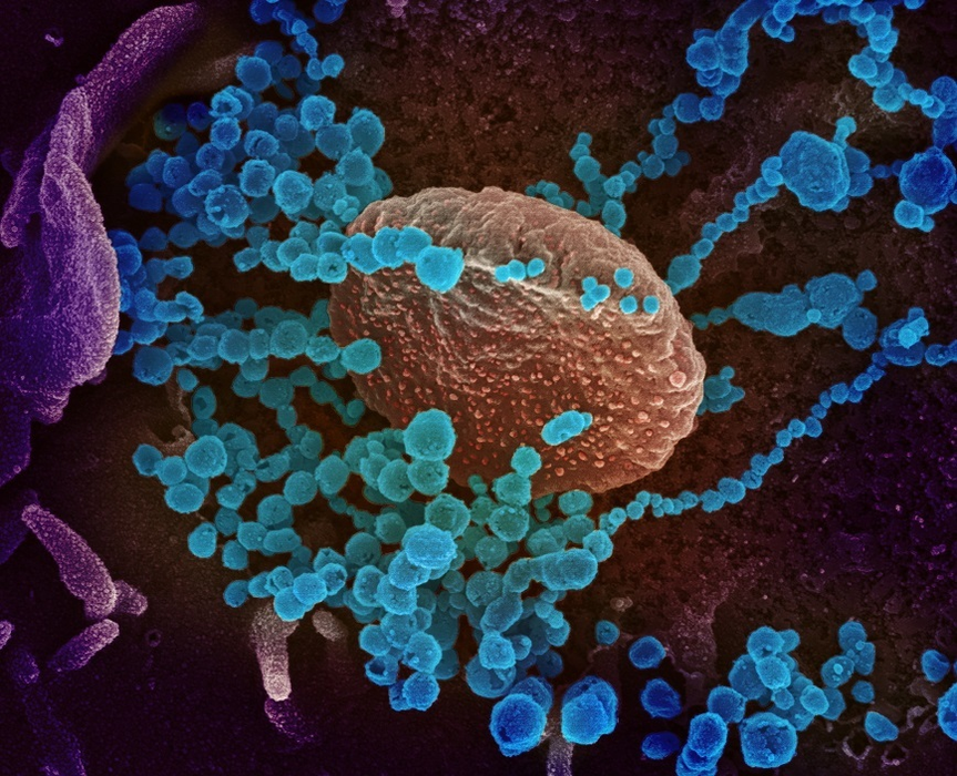 epa08252657 An undated handout picture made available by the National Institutes of Health (NIH) shows a scanning electron microscope image of SARS-CoV-2 (round blue objects) emerging from the surface of cells cultured in the lab (issued 27 February 2020). SARS-CoV-2, also known as 2019-nCoV, is the virus that causes COVID-19. The virus shown was isolated from a patient in the USA.  The novel coronavirus is on the verge of spreading across the world as more cases are emerging outside China with outbreaks in South Korea, Italy and Iran.  EPA/NIAID- RML/NATIONAL INSTITUTES OF HEALTH HANDOUT  HANDOUT EDITORIAL USE ONLY/NO SALES