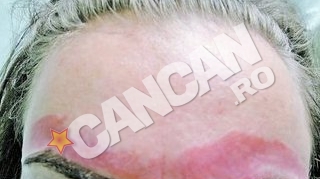 O suceveanca a ajuns la Spitalul de Urgenta din Iasi! Arsa pe fata de ceara de la cosmetica