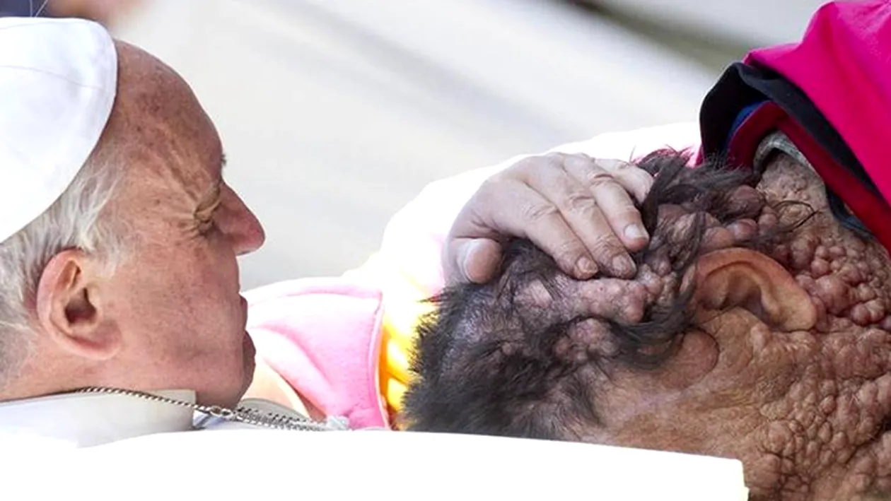 Imaginea care a făcut inconjurul lumii! Papa Francisc imbrătisează un om desfigurat, cu dureri cumplite