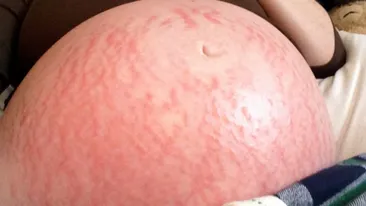 Avea o alergie de care nu scăpa cât timp a fost gravidă. Ce diagnostic crunt a primit tânăra de la medici