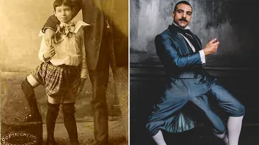 Bărbatul din imagine s-a născut cu 3 picioare și 2 organe genitale, fiind rezultatul unui frate geamăn unit cu el la naștere. Câte degete avea în total