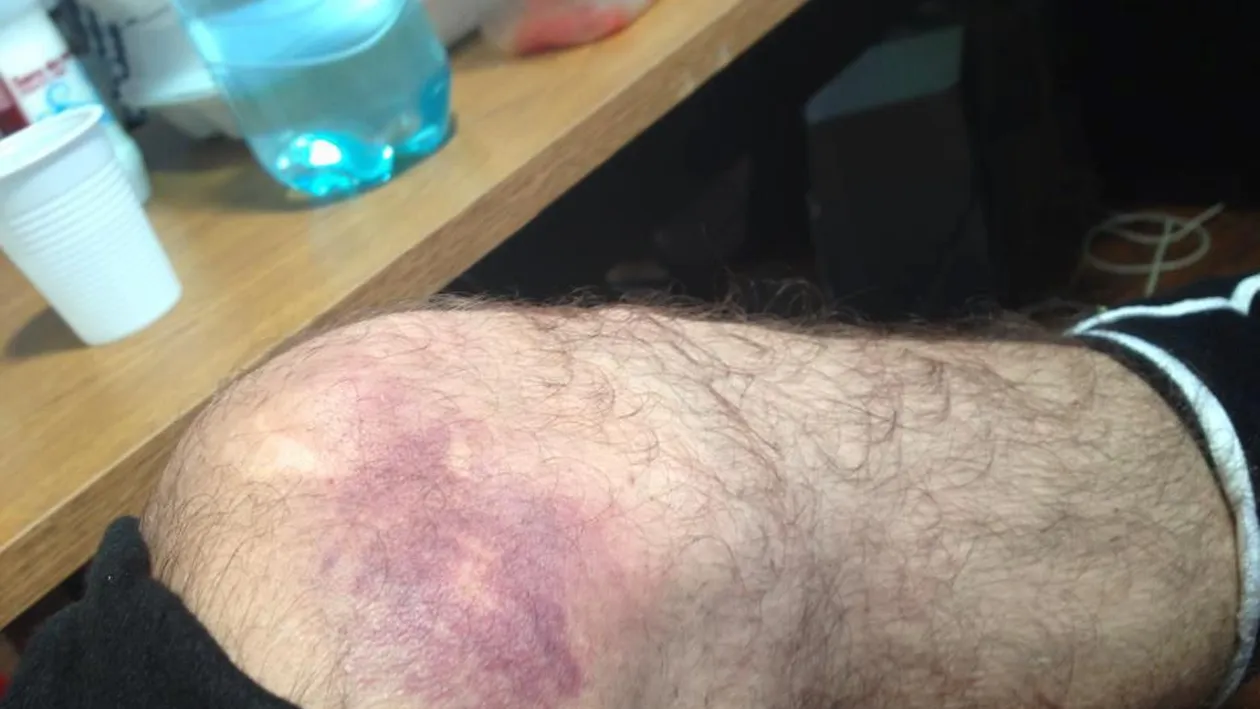 Serban, de la Animal X, s-a accidentat grav! Uite cu ce vanataie groaznica s-a ales in urma unui antrenament de la Dansez pentru tine!