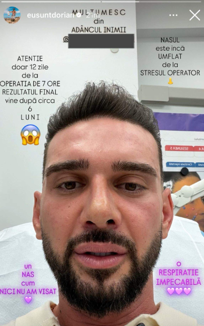 Cum arată nasul lui Dorian Popa după 12 zile de la operație/ sursă foto: social media
