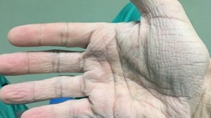 Emoţionant! Cum arată mâna unui chirurg din România, după 12 ore de muncă 