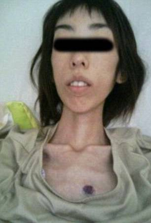 Bunicul ei i-a interzis să mănânce, iar ea a ajuns să cântărească 16 kilograme! A fost la un prag de moarte! Imagini înfiorătoare