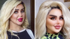 Dalia a vrut să arate ca păpușa Barbie, dar rezultatul i-a șocat pe apropiați. După 43 de operații, tânăra de 30 de ani este asemănată cu un zombi