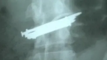 Incredibil! A vrut sa se omoare inghitind 9 cuie si o bucata de sticla!