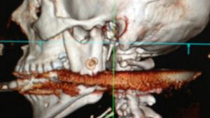 HORROR! Cum arata aceasta tanara frumoasa frumoasa dupa ce a fost "impuscata" cu un harpon in gat